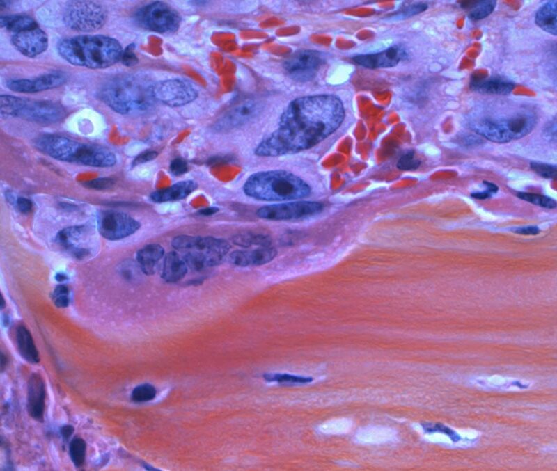 A microscopic slide showing a tumor